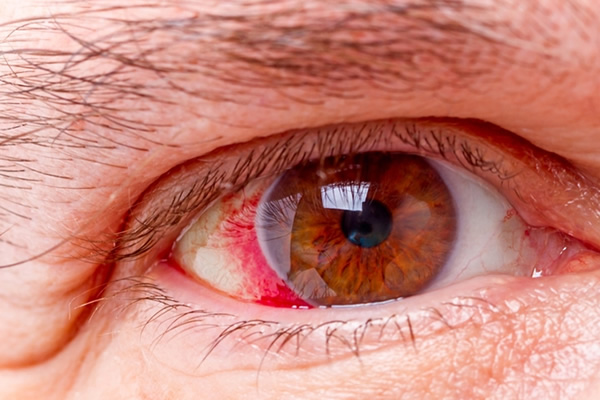 Glaucoma